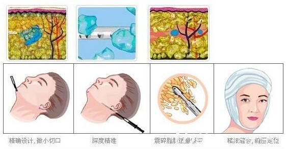 面部吸脂手术原理