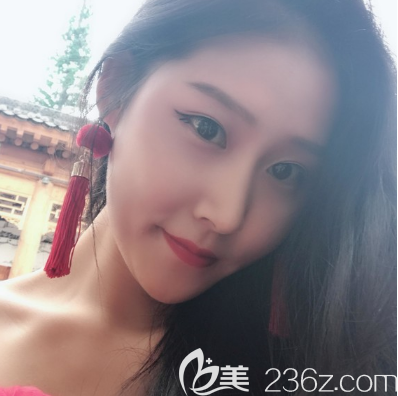 中信惠州医院整形科双眼皮隆鼻25天效果图