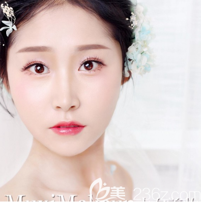 中信惠州医院整形科陈虹双眼皮隆鼻案例