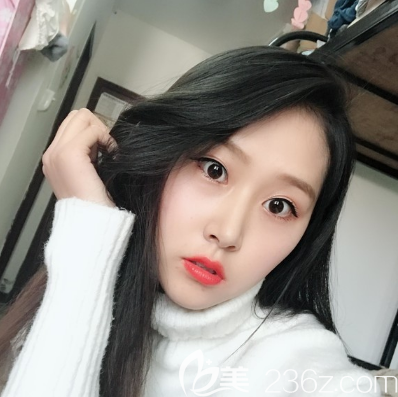 看完我找陈虹做的双眼皮隆鼻效果再决定要不要去中信惠州医院整形科