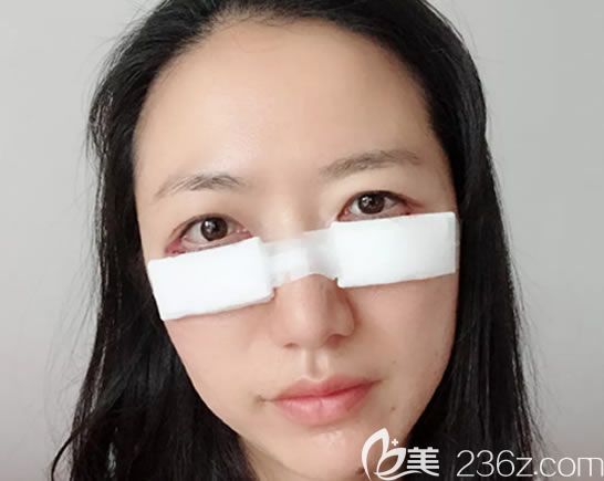 祛眼袋手术第2天眼部裹着纱布