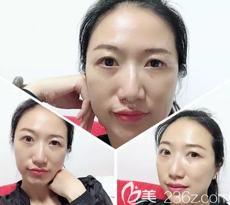 割眼袋第7天眼部淤青已经消退