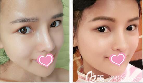 福州台江鼻综合整形案例 福州台江鼻综合整形案例