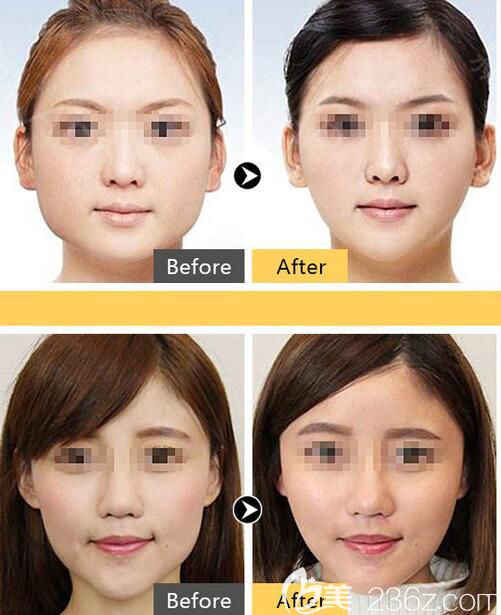 福州台江注射瘦脸效果对比 福州台江注射瘦脸效果对比