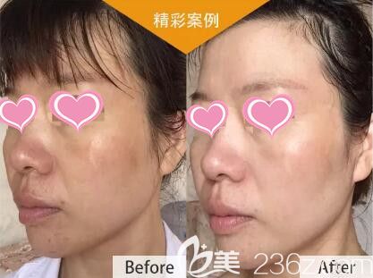 CP焕颜水光真人前后效果对比