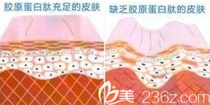 有胶原蛋白与没有胶原蛋白皮肤的状况
