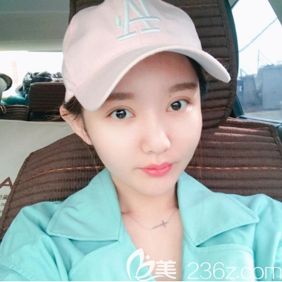 纠结了两年终于在东莞华美找詹慧医生给我做了全切双眼皮