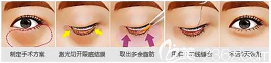 内切法去眼袋手术示意图