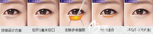 外切法去眼袋手术示意图
