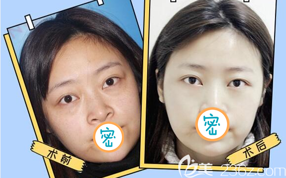 乐山达芬奇内切去眼袋术前术后对比