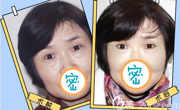 乐山达芬奇外切去眼袋前后对比图