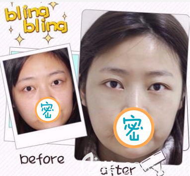 乐山达芬奇整形激光去眼袋案例