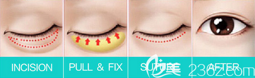 激光去眼袋手术示意图