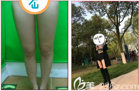 大腿吸脂前后对比效果