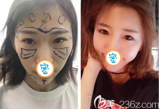 全面部脂肪填充术后效果图