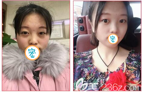 乐山达芬奇去眼袋案例