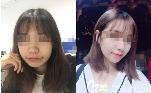 乐山达芬奇术后效果