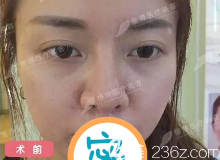 隆鼻失败后我准备尝试鼻修复手术 隆鼻失败后我准备尝试鼻修复手术