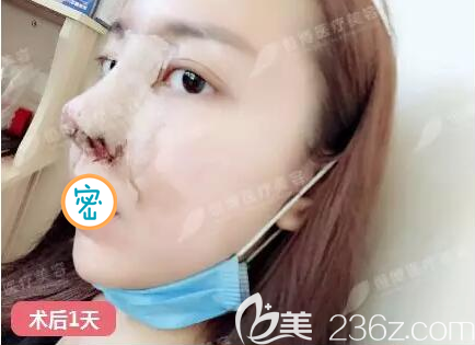 半肋鼻综合术后即刻照片 半肋鼻综合术后即刻照片