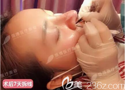 膨体+肋软骨鼻综合术后7天拆线 膨体+肋软骨鼻综合术后7天拆线