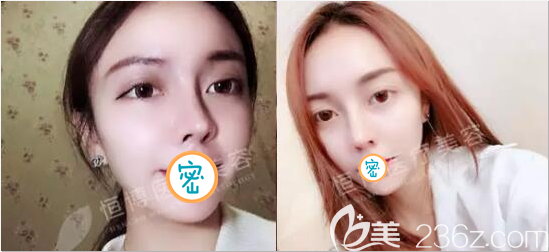 肋软骨鼻综合术后8个月美照 肋软骨鼻综合术后8个月美照