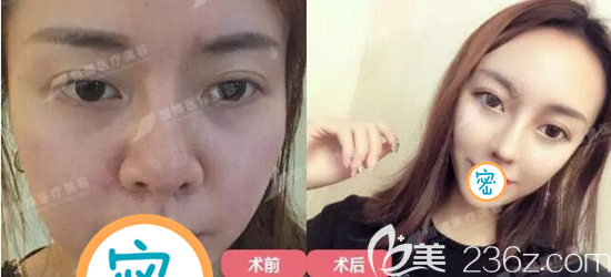 <!--<i data=20240703-sp></i>-->美容医院半肋鼻综合修复术前术后对比 <!--<i data=20240703-sp></i>-->美容医院半肋鼻综合修复术前术后对比