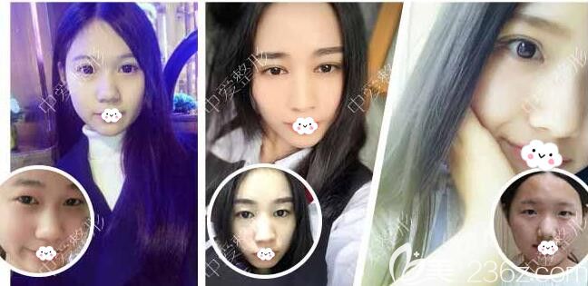 黄石中爱万文勇双眼皮案例效果对比图
