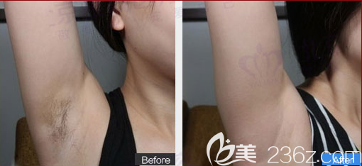 北京雅靓张研研医生激光脱毛案例 北京雅靓张研研医生激光脱毛案例