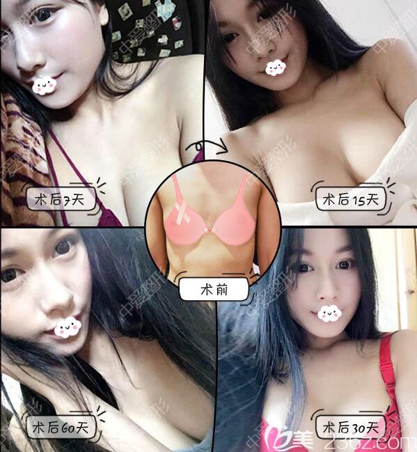 黄石中爱假体隆胸案例恢复过程图