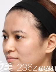 找片桐衣理为我脸部注射玻尿酸前 找片桐衣理为我脸部注射玻尿酸前