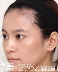 在衣理整形医院找片桐衣理为我脸部注射玻尿酸，七天后年轻回少女脸