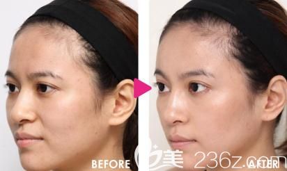 找片桐衣理为我脸部注射玻尿酸前后对比 找片桐衣理为我脸部注射玻尿酸前后对比