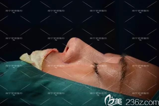 南宁梦想唐超给我做鼻综合和丰下巴术后即刻