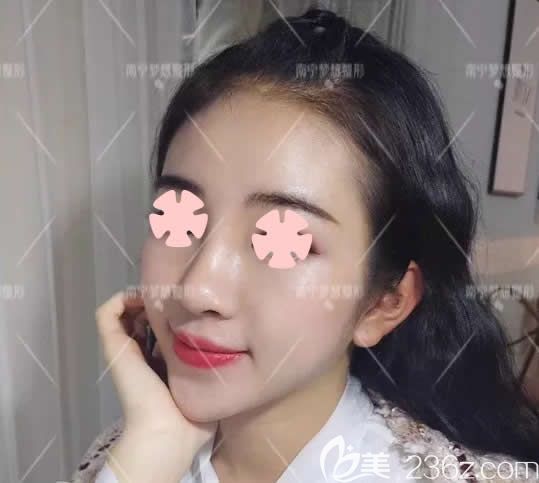 我在南宁梦想整形做鼻综合和垫下巴术后第7天