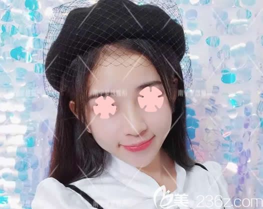  速来围观:我一个月前找南宁梦想整形唐超院长做鼻综合隆鼻+玻尿酸丰下巴前后对比照片