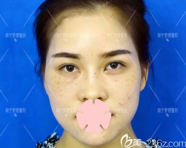 我在南宁梦想整形做超皮秒激光祛斑前的照片 我在南宁梦想整形做超皮秒激光祛斑前的照片