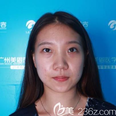 在广州美恩整形术前照片 在广州美恩整形术前照片