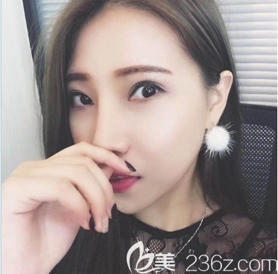 找广州美恩陈宏彬做了双眼皮隆鼻手术 找广州美恩陈宏彬做了双眼皮隆鼻手术