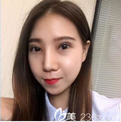 广州美恩陈宏彬医生双眼皮隆鼻案例效果图 广州美恩陈宏彬医生双眼皮隆鼻案例效果图