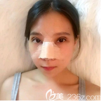 广州美恩双眼皮隆鼻案例术后5天 广州美恩双眼皮隆鼻案例术后5天