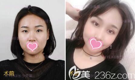 刘欢双眼皮整形真人前后<span style= 刘欢双眼皮整形真人前后<span style=