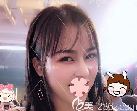 激光祛斑效果如何？上传我在南宁梦想整形做超皮秒激光祛斑恢复效果图片