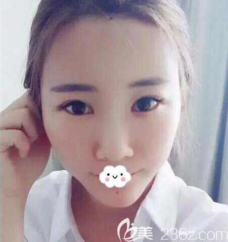 全面部脂肪填充后第5天的照片