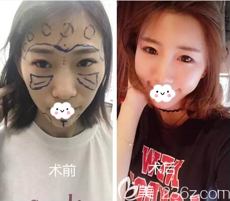 <!--<i data=20240703-sp></i>-->自体脂肪填充全面部术后对比
