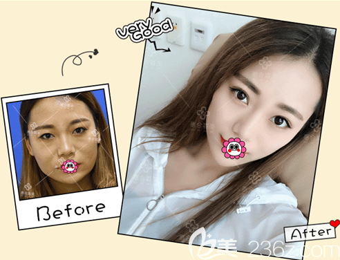 北京惠合嘉美面部射频美肤案例