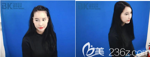 这是我手术做完之后的侧脸和正脸的样子