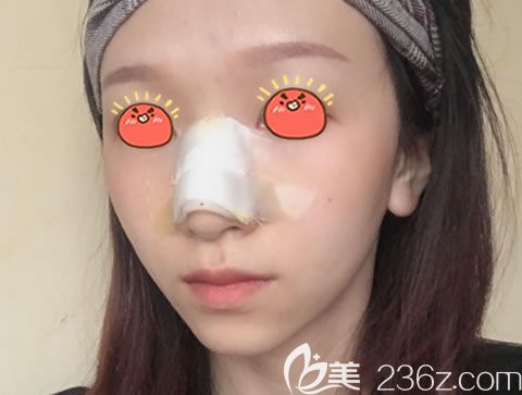 嘉兴曙光医院做驼峰鼻矫正效果