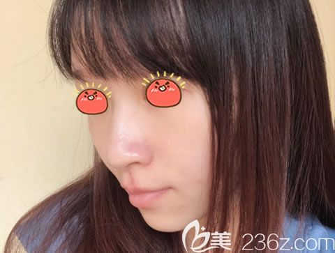 嘉兴曙光整形医院鼻综合案例