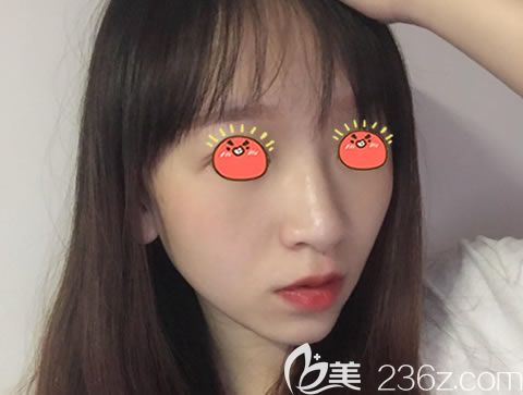 嘉兴曙光高俊鼻综合案例15天效果