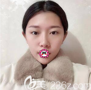 在北京艺星做眼综合前样子 在北京艺星做眼综合前样子